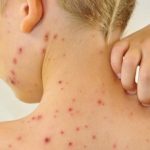 Кір і його профілактика